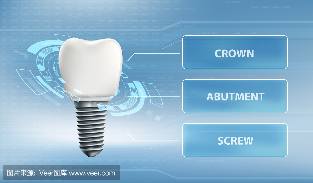 带牙冠和螺钉的种植体。用户界面技术。